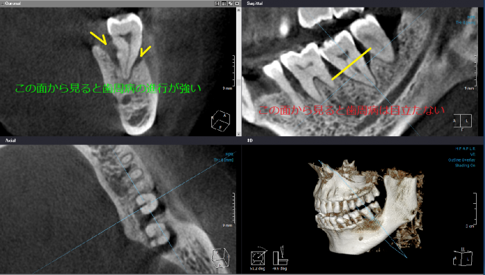 歯科用CT撮影前歯根端口頬舌方向のP侵襲写真